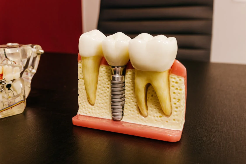Dental Implants lexington ky