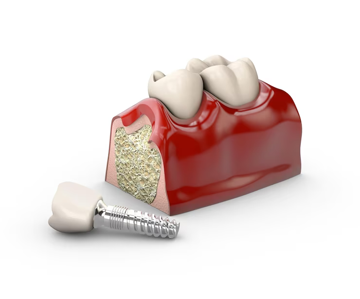 single tooth implant pittsburgh pa